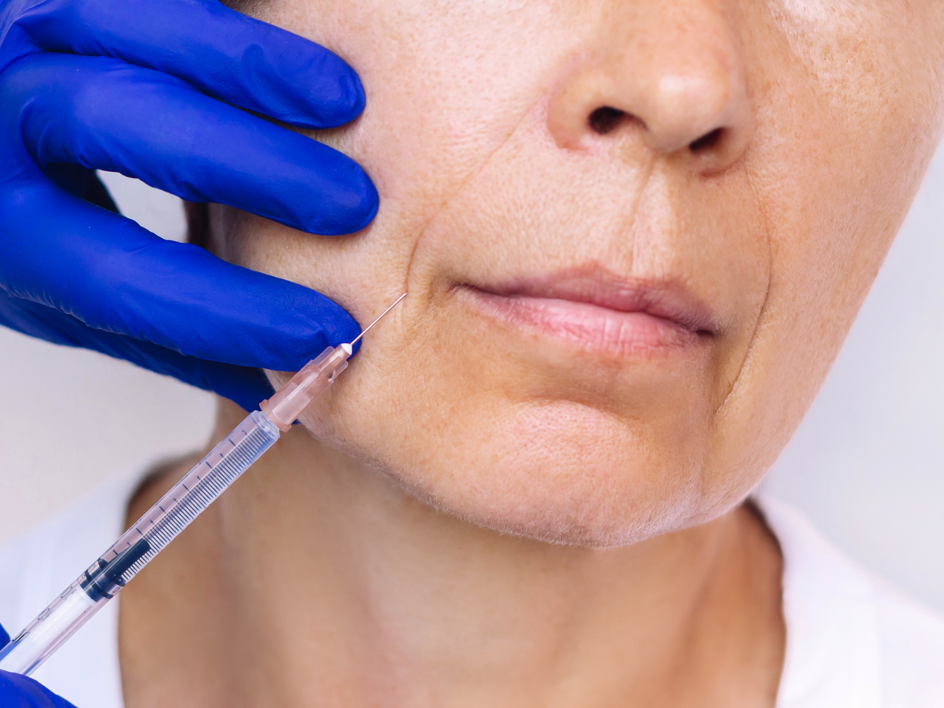 Mundwinkel Botox® Injektion Behandlung